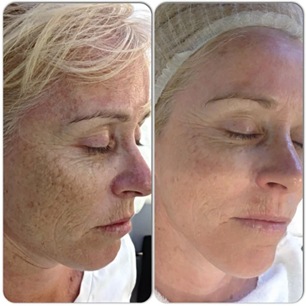 Resultaten van microneedling